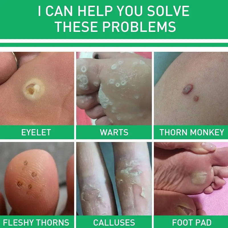 Foot Care Cream for Calluses, Warts, and Smooth Skin