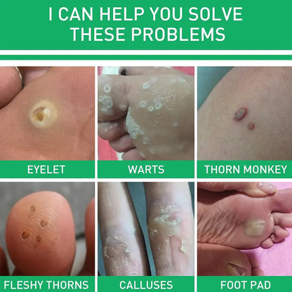 Foot Care Cream for Calluses, Warts, and Smooth Skin