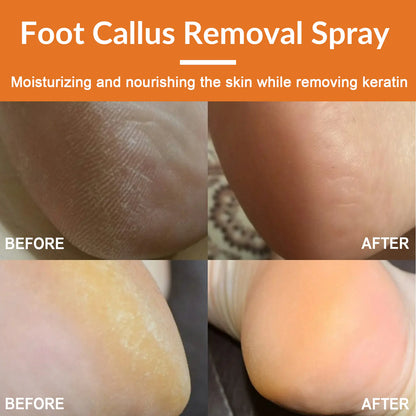 South Moon Foot Exfoliating Spray for Rough Skin Care