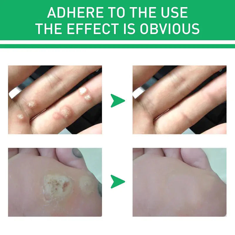 Foot Care Cream for Calluses, Warts, and Smooth Skin